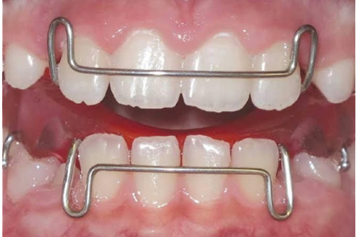 Interceptive orthodontic treatment given to a child
